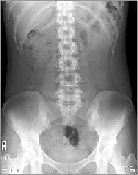 腹部レントゲン